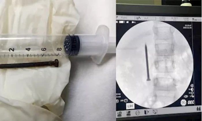 فريق طبي بجامعة المنوفية ينجح في استخراج مسمار حاد من أمعاء طفلة فريق طبي بجامعة المنوفية ينجح في استخراج مسمار حاد من أمعاء طفلة