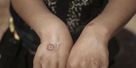 "حبة حلب" جنوب سوريا تصيب العشرات - المصدر 24