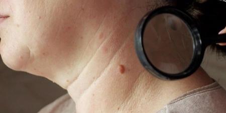 الشامات المريبة.. العلامات التحذيرية وأخطر الأماكن على الجسم - المصدر 24