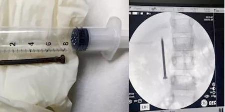 فريق طبي بجامعة المنوفية ينجح في استخراج مسمار حاد من أمعاء طفلة - المصدر 24