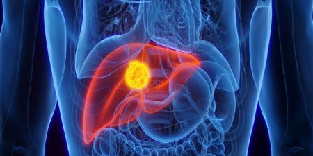 نهج واعد لمرضى سرطان الكبد المتقدم - المصدر 24