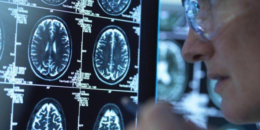 اكتشاف علمي يفتح آفاقاً جديدة لعلاج ألزهايمر باستخدام مادة طبيعية في الجسم - المصدر 24