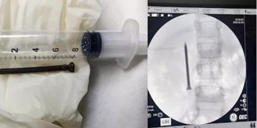 فريق طبي بجامعة المنوفية ينجح في استخراج مسمار حاد من أمعاء طفلة - المصدر 24