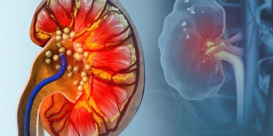 "بول الثعابين" قد يمهّد لتقنيات جديدة لعلاج النقرس وحصوات الكلى - المصدر 24