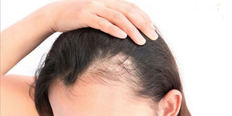 حساسية الجلوتين وداء الثعلبة .. بدائل غذائية لتحسين صحة شعرك - المصدر 24