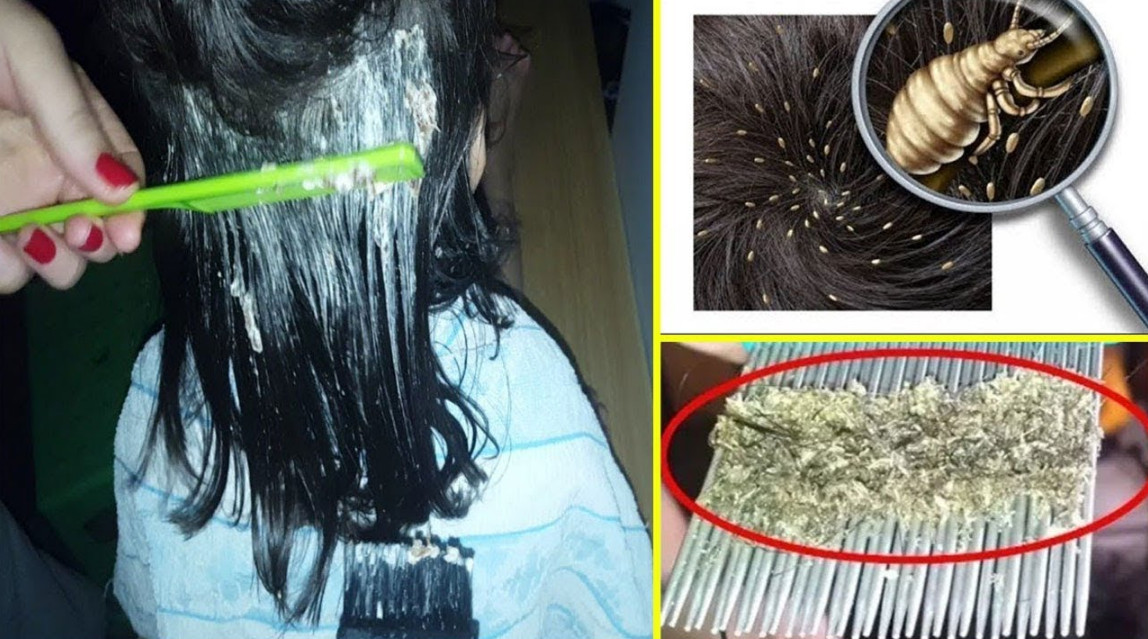 تجربتي في التخلص من بيض القمل (الصيبان) نهائياً وبطرق مجربة في المنزل!.. وداعاً للإحراج والقلق